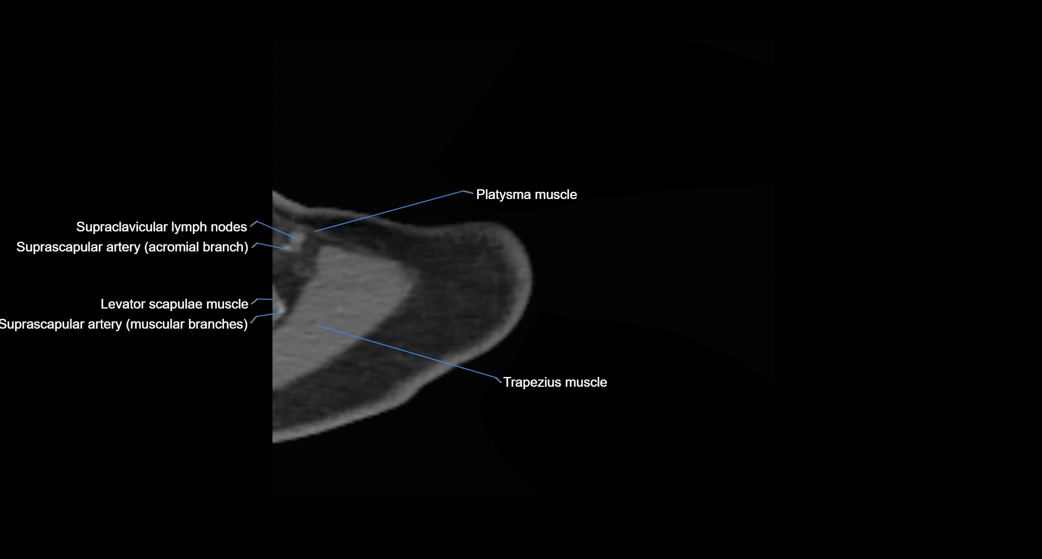 CT Shoulder axial cross sectional anatomy labelled radiology image -00004.webp